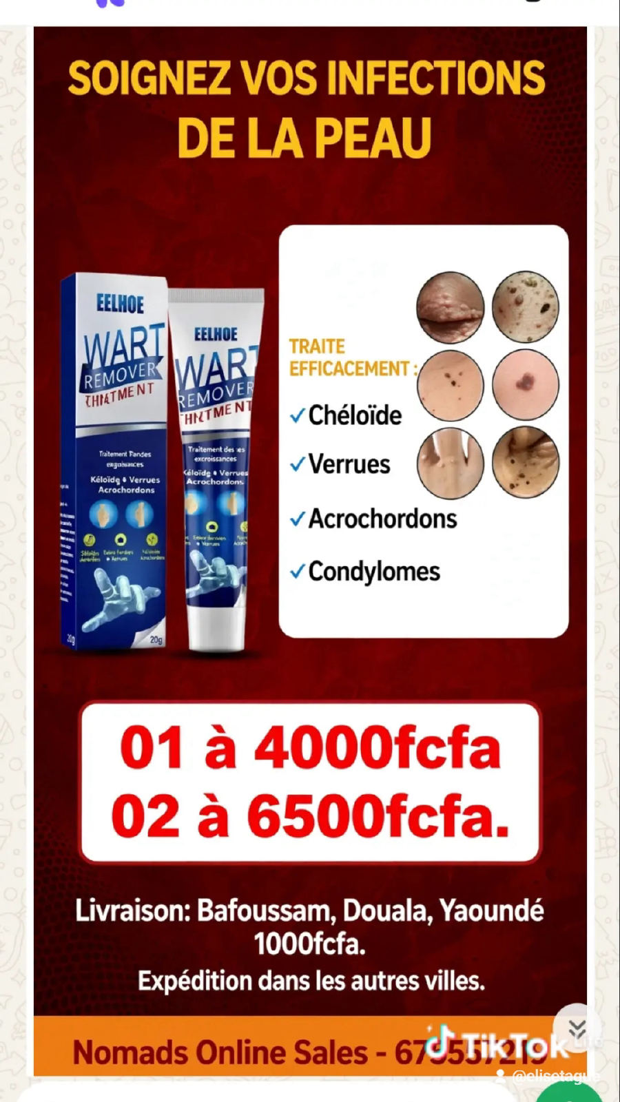 Wart